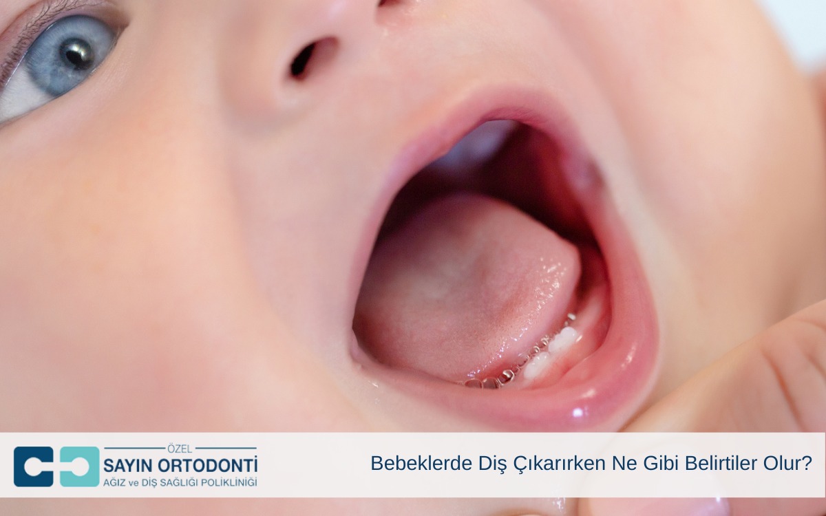 Bebeklerde Diş Çıkarırken Ne Gibi Belirtiler Olur