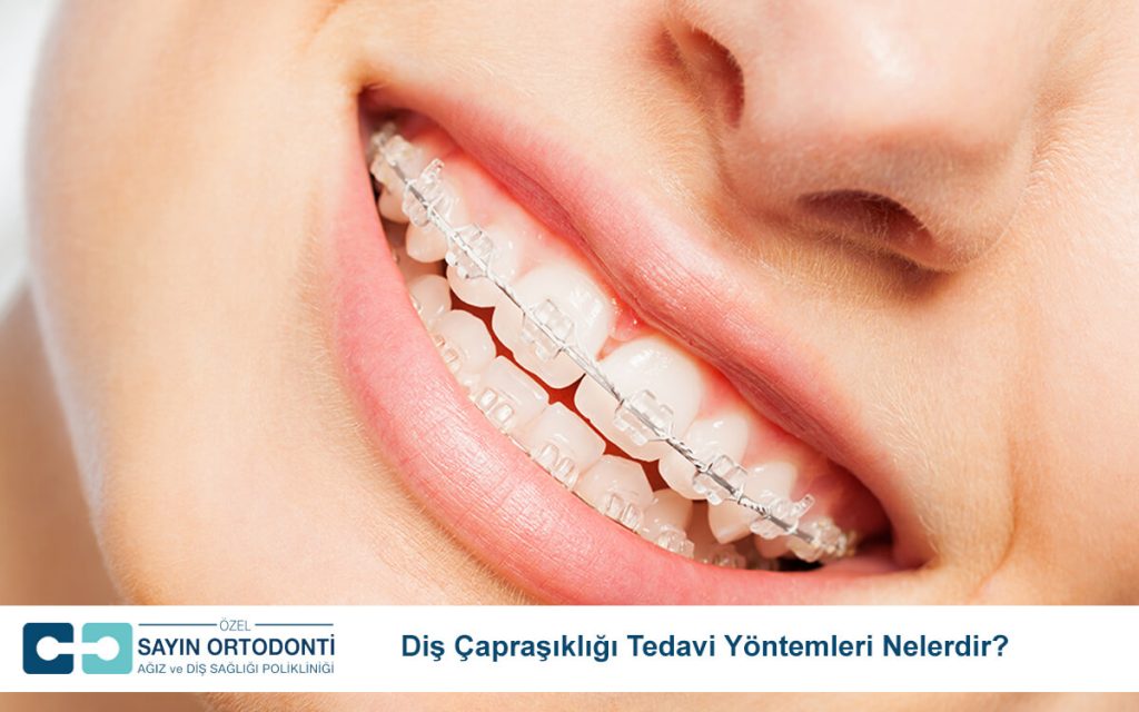 Diş Çapraşıklığı Tedavi Yöntemleri