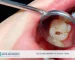 Diş Çürüğü Belirtileri ve Çözüm Yolları