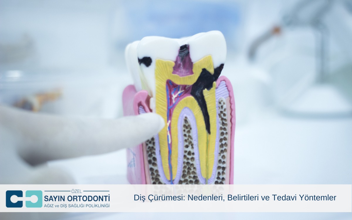 Diş Çürümesi: Nedenleri, Belirtileri ve Tedavi Yöntemler