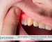 Diş Eti İltihabı ve Periodontal Hastalıklar: Belirtileri ve Tedavi Yöntemleri
