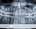 Gömülü Dişler ve Ortodonti Tedavisi Etkili Çözümler