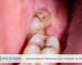 Gömülü Dişlerin Tedavisinde Yeni Yöntemler ve Teknolojiler