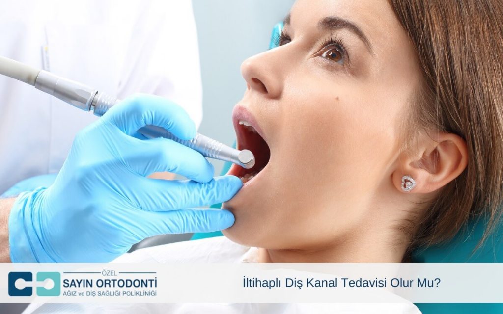 İltihaplı Diş Kanal Tedavisi Olur Mu