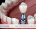 İmplant Tedavisi: Kayıp Dişler İçin Kalıcı Çözümler