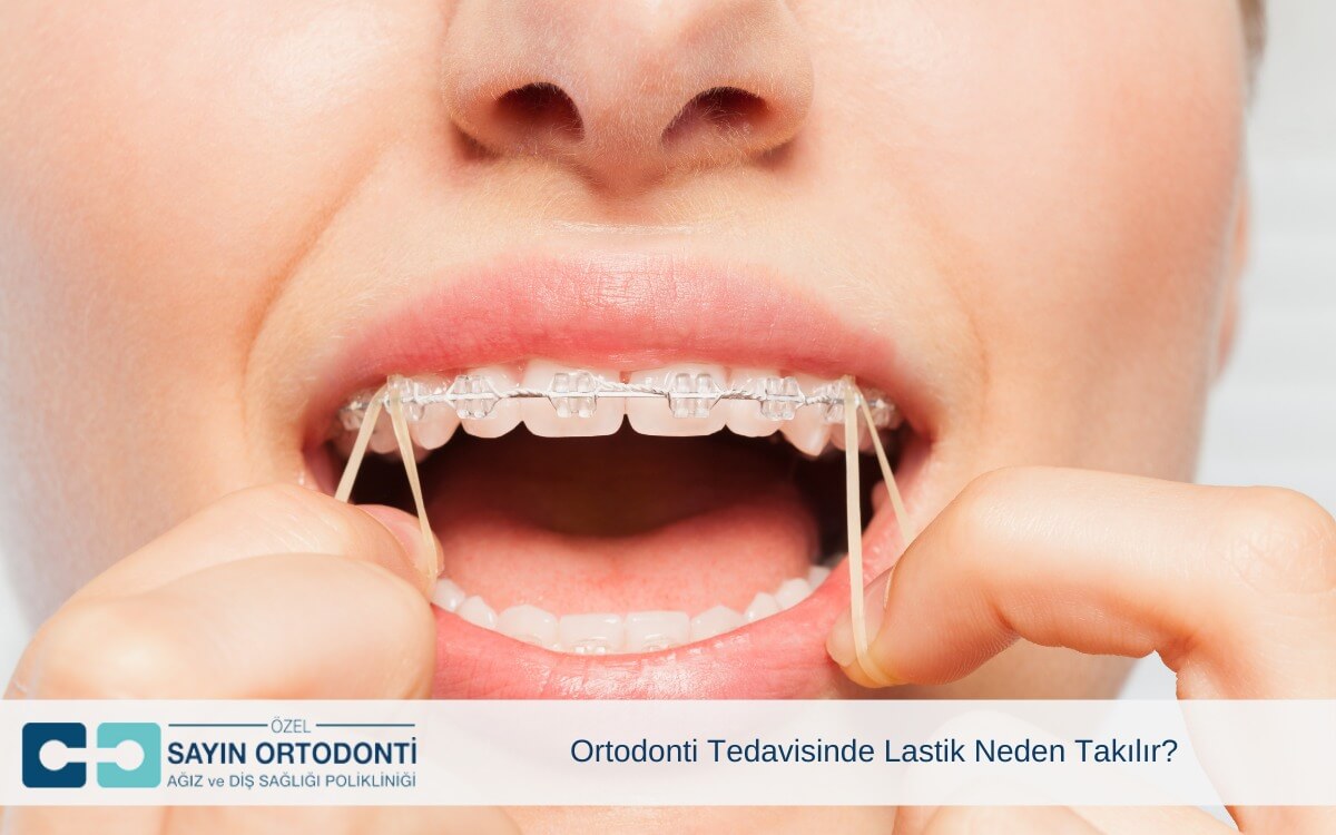 Ortodonti Tedavisinde Lastik Neden Takılır